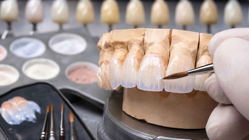Fluorescence in E.max Veneers What Can the Lab Customize