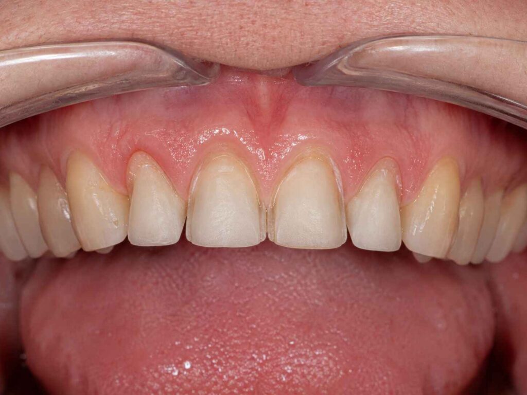 Interproximal Extension for Veneers Hiding Margins Without Overcontouring