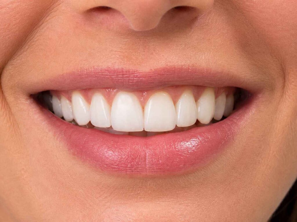 Interproximal Extension for Veneers Hiding Margins Without Overcontouring