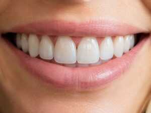 Polished vs Glazed Veneers Which Finish Creates More Natural Light Reflection
