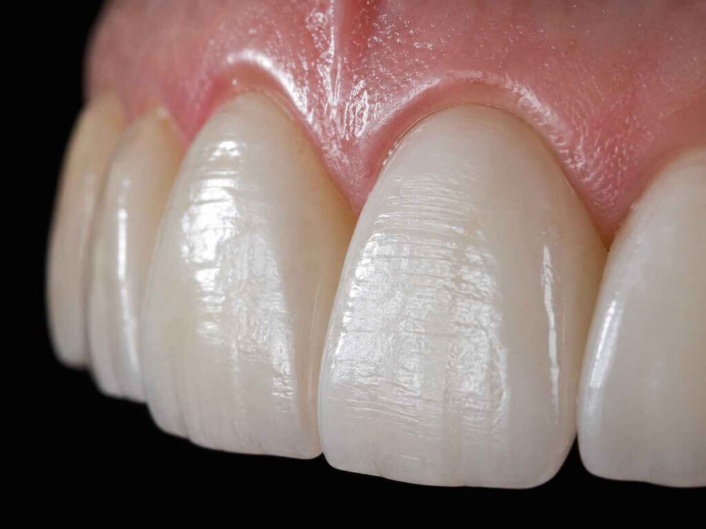 Polished vs Glazed Veneers Which Finish Creates More Natural Light Reflection