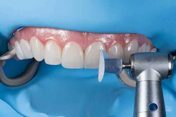 Post-Cementation Occlusal Checks for Multi-Veneer Cases