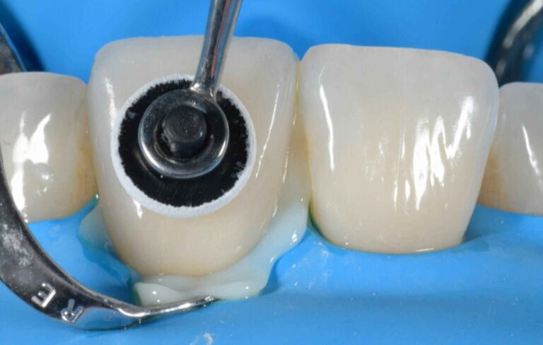 Post-Cementation Occlusal Checks for Multi-Veneer Cases