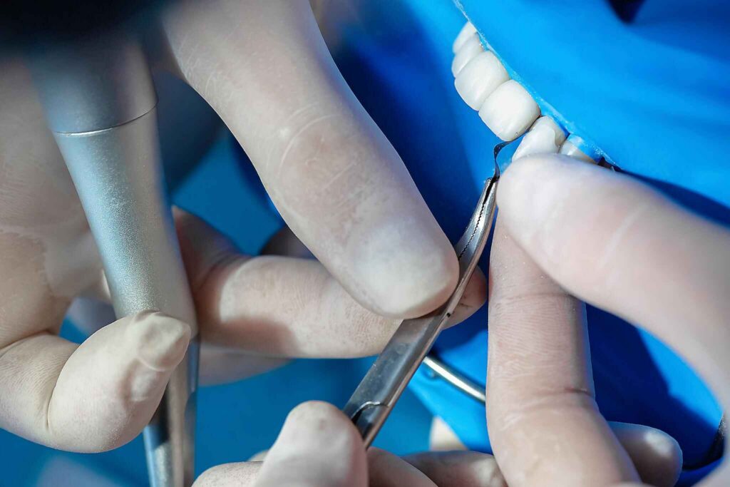 Post-Cementation Occlusal Checks for Multi-Veneer Cases