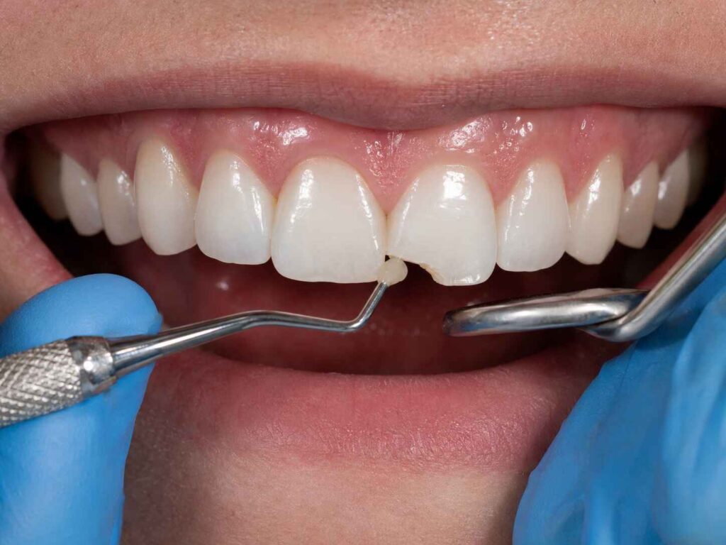 Repairing a Chipped Zirconia Veneer When Is Composite Temporary
