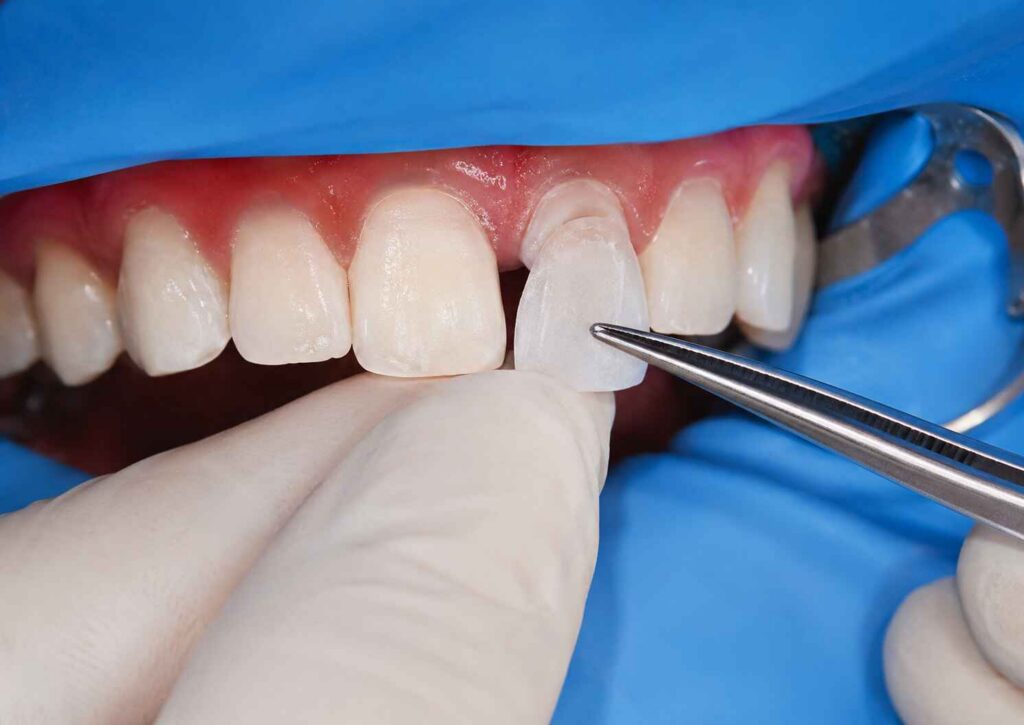 Seating Pressure and Cement Film Thickness in Ultra-Thin Veneers