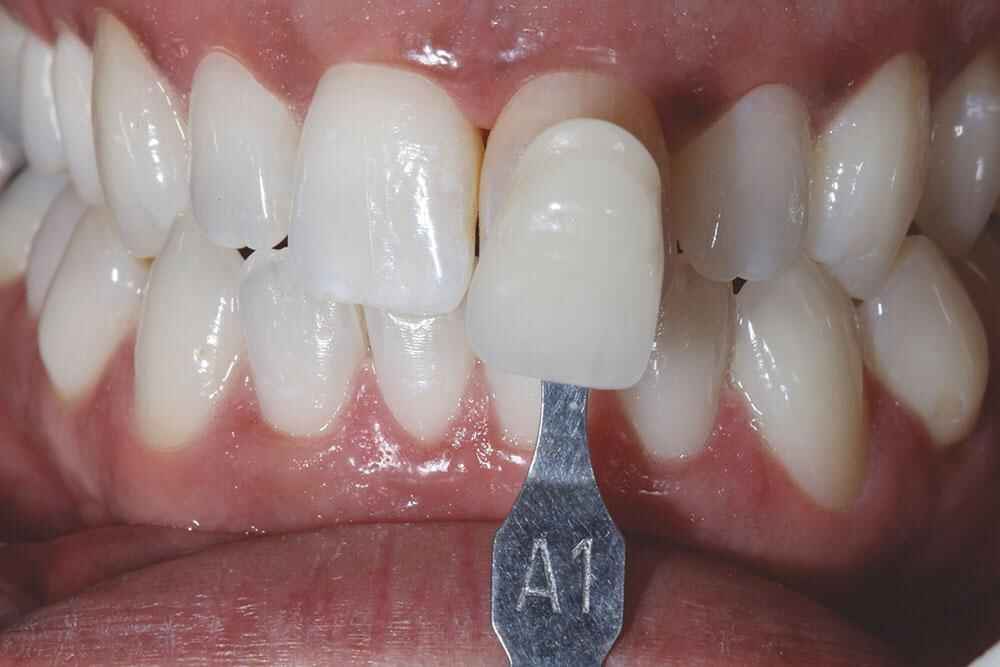Single Veneer vs Multi-Unit Veneers Why Matching Difficulty Changes