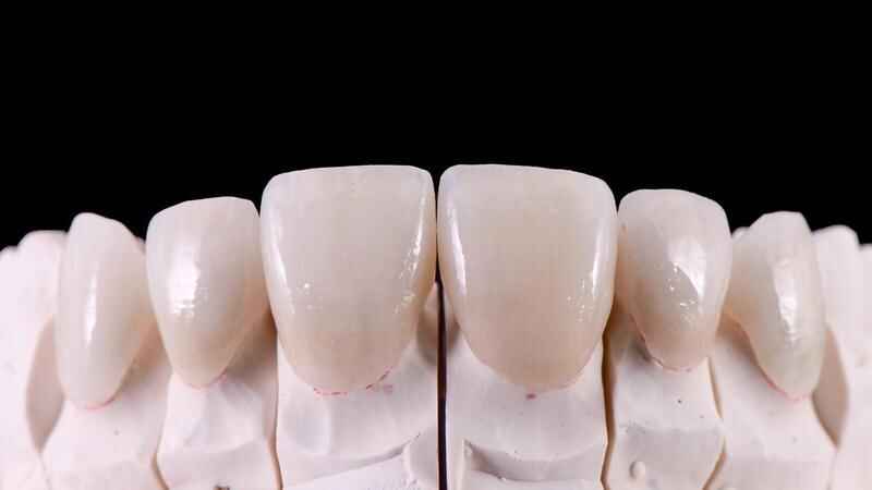 Single Veneer vs Multi-Unit Veneers Why Matching Difficulty Changes