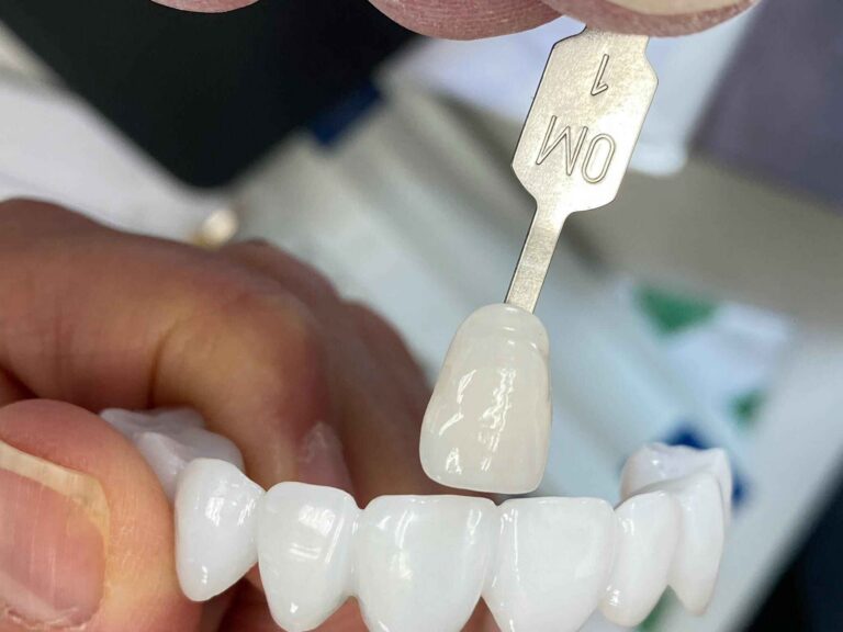 Single Veneer vs Multi-Unit Veneers Why Matching Difficulty Changes