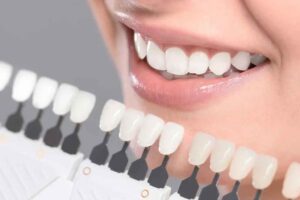 Veneer Preparation for Protrusive Teeth Managing Profile and Lip Support