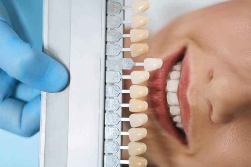 Veneer Preparation for Protrusive Teeth Managing Profile and Lip Support
