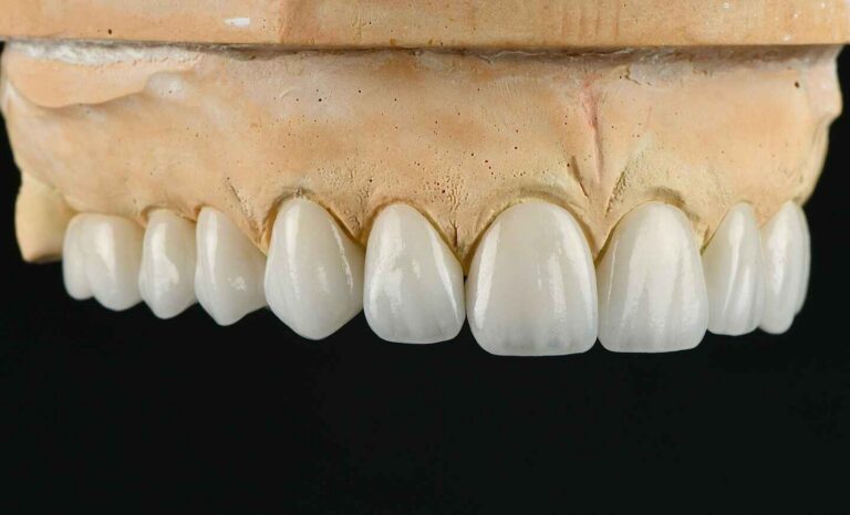 What Veneer Case Photos Reveal About a Lab's True Esthetic Skill