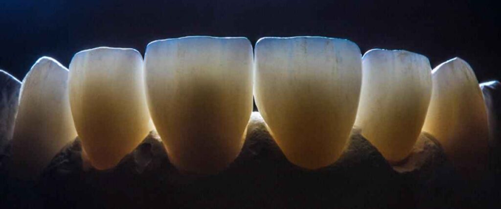 Come redigere una prescrizione per il laboratorio di faccette dentali per ottenere una texture naturale e un comportamento alla luce naturale