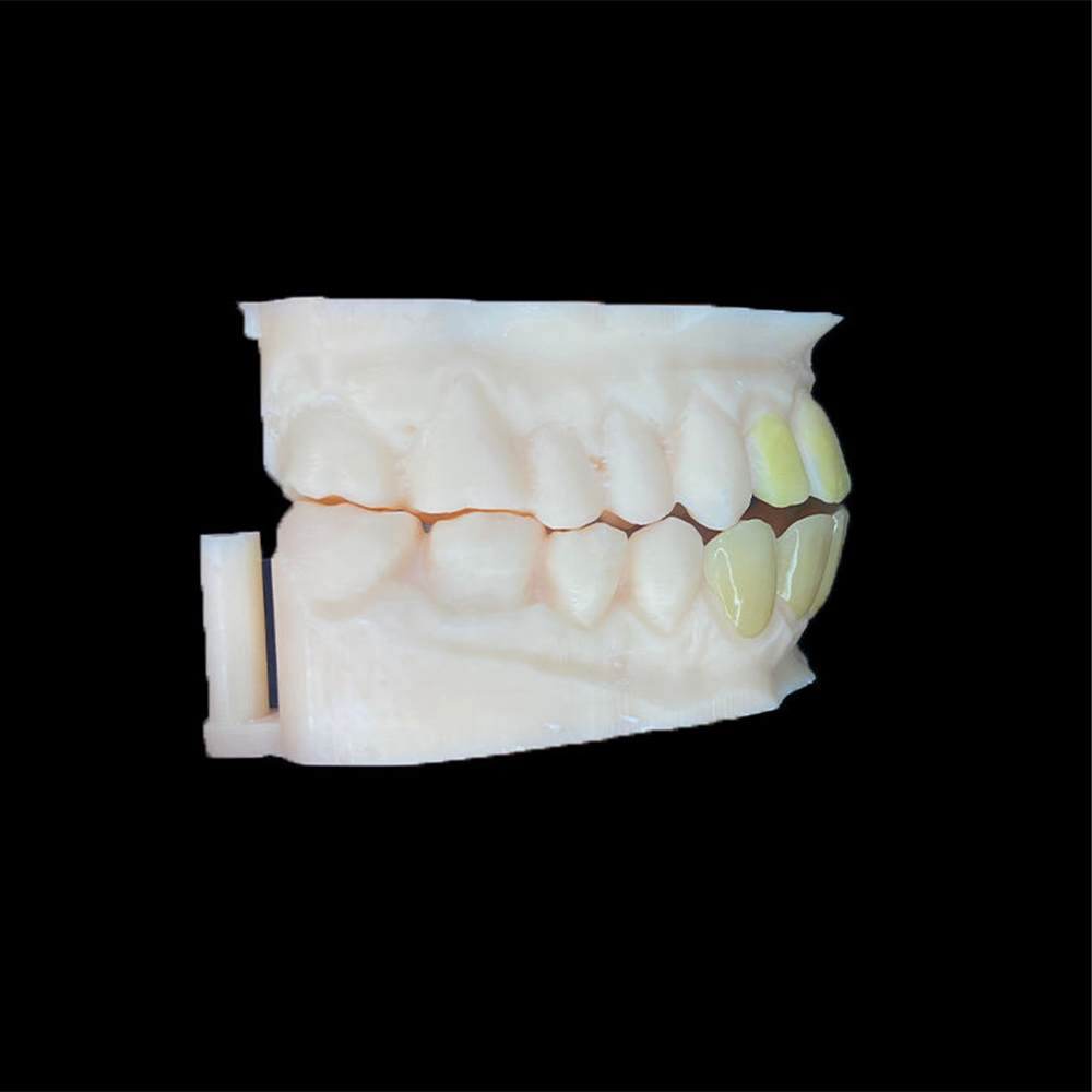 Cleaning Zirconia Veneers After Saliva-Contaminated Try-In