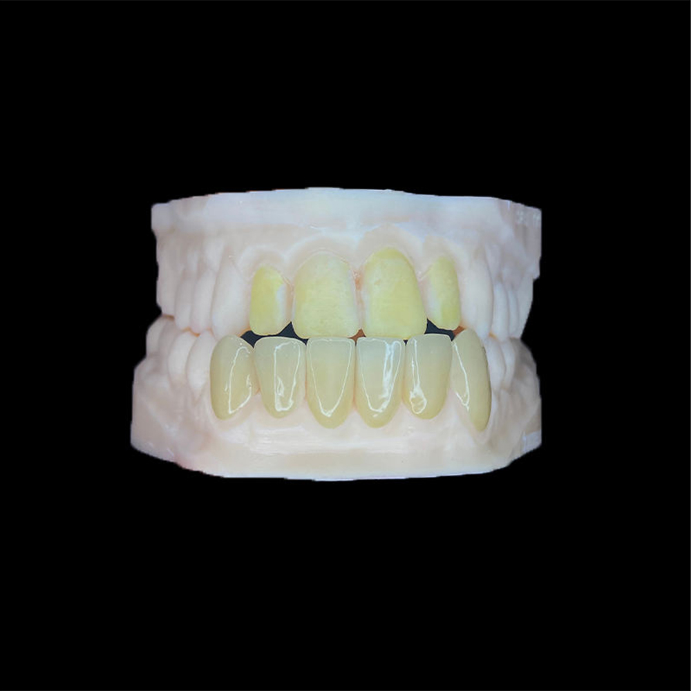 Cleaning Zirconia Veneers After Saliva-Contaminated Try-In