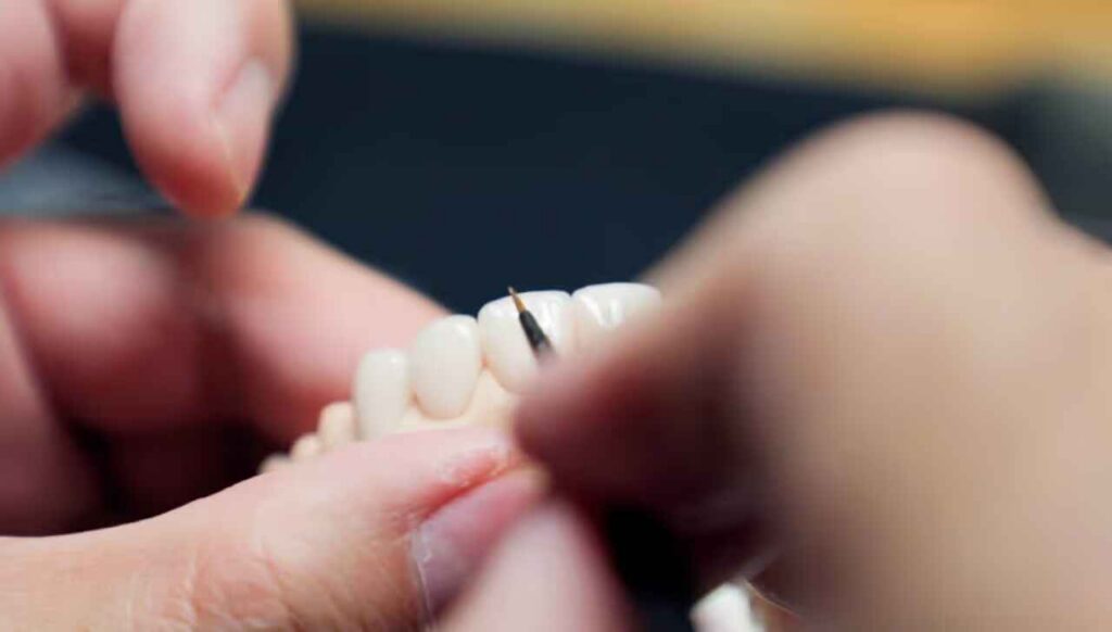 Complete Veneer Preparation Design Guide Window, Incisal Bevel, and Palatal Overlap