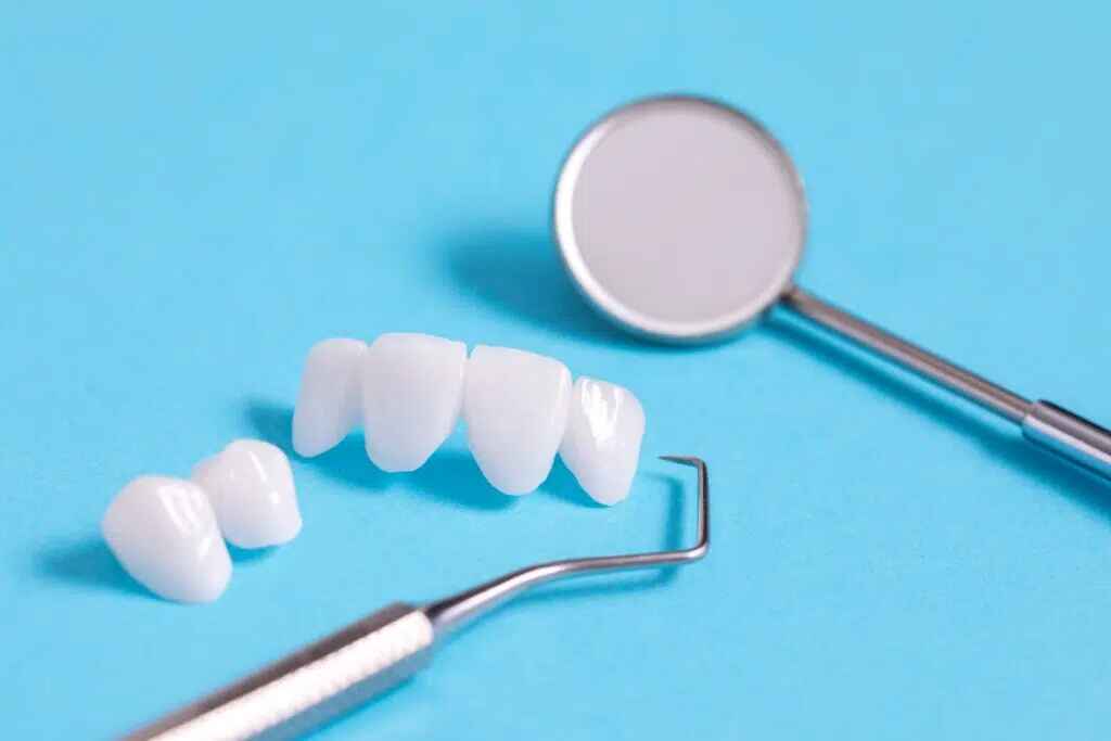 Complete Veneer Preparation Design Guide Window, Incisal Bevel, and Palatal Overlap