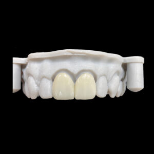 E.max Veneer