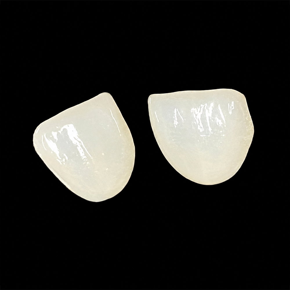 E.max Veneer