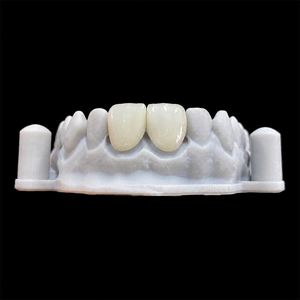 E.max Veneer