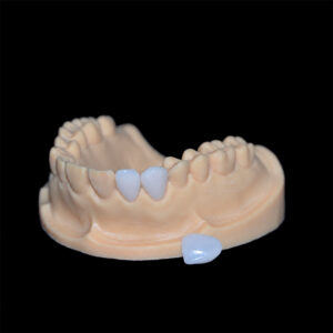 E.max Veneers