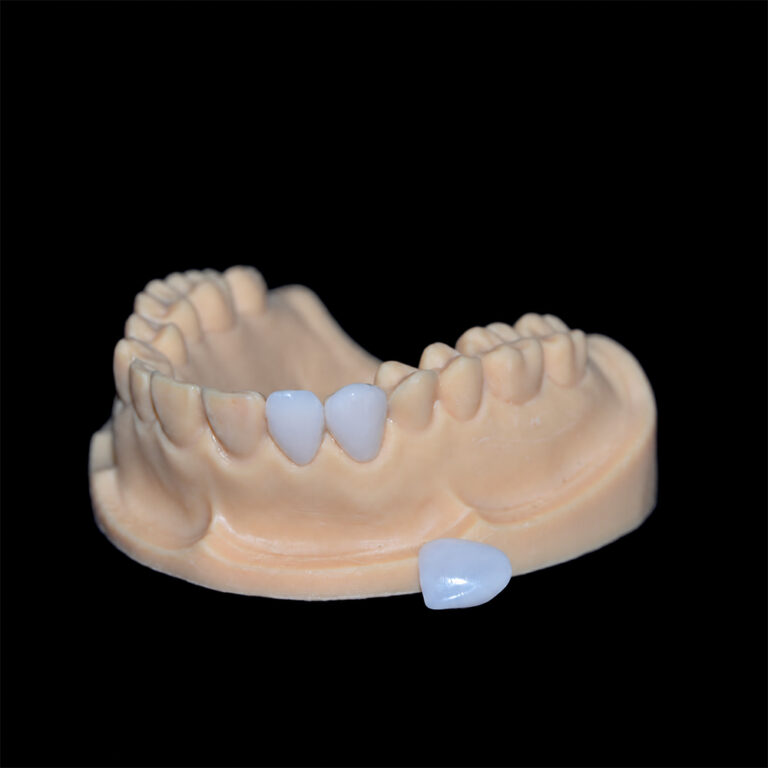 E.max Veneers