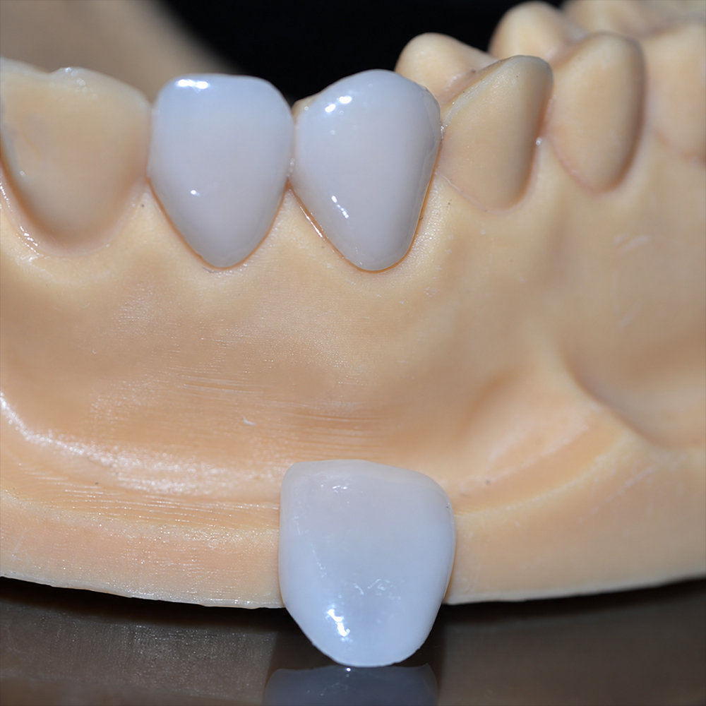 E.max Veneers