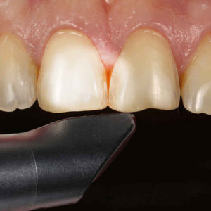 How to Scan Veneer Preparations Without Losing Thin Finish Lines