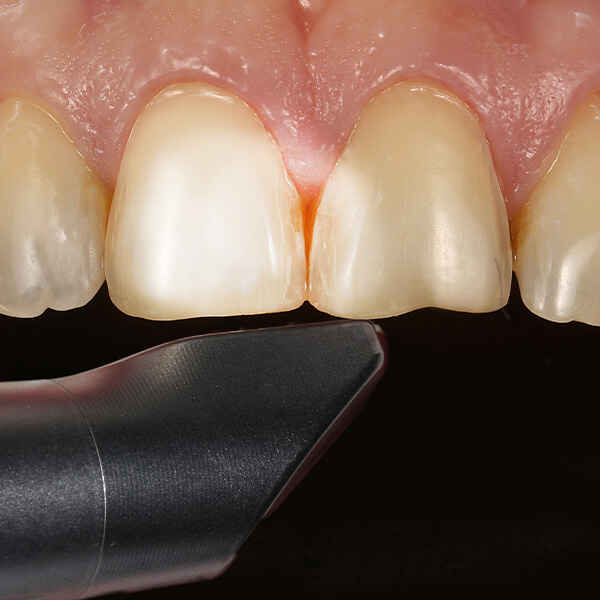 How to Scan Veneer Preparations Without Losing Thin Finish Lines