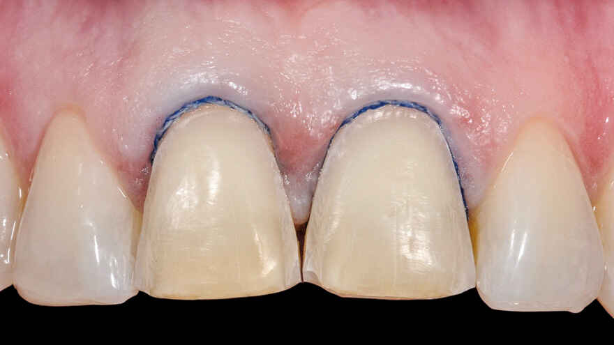 How to Scan Veneer Preparations Without Losing Thin Finish Lines