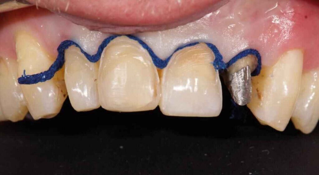 How to Scan Veneer Preparations Without Losing Thin Finish Lines
