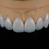 Feldspathic Veneer