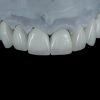 Full-Contouring-Multi-layer-Zirconia