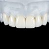 Full-E.max-Veneer