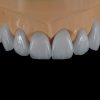 Layered E.max Veneer​