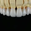 Layered Zirconia Crown